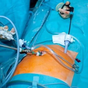 Laparoscopic (Keyhole) Gynaecological Surgery
