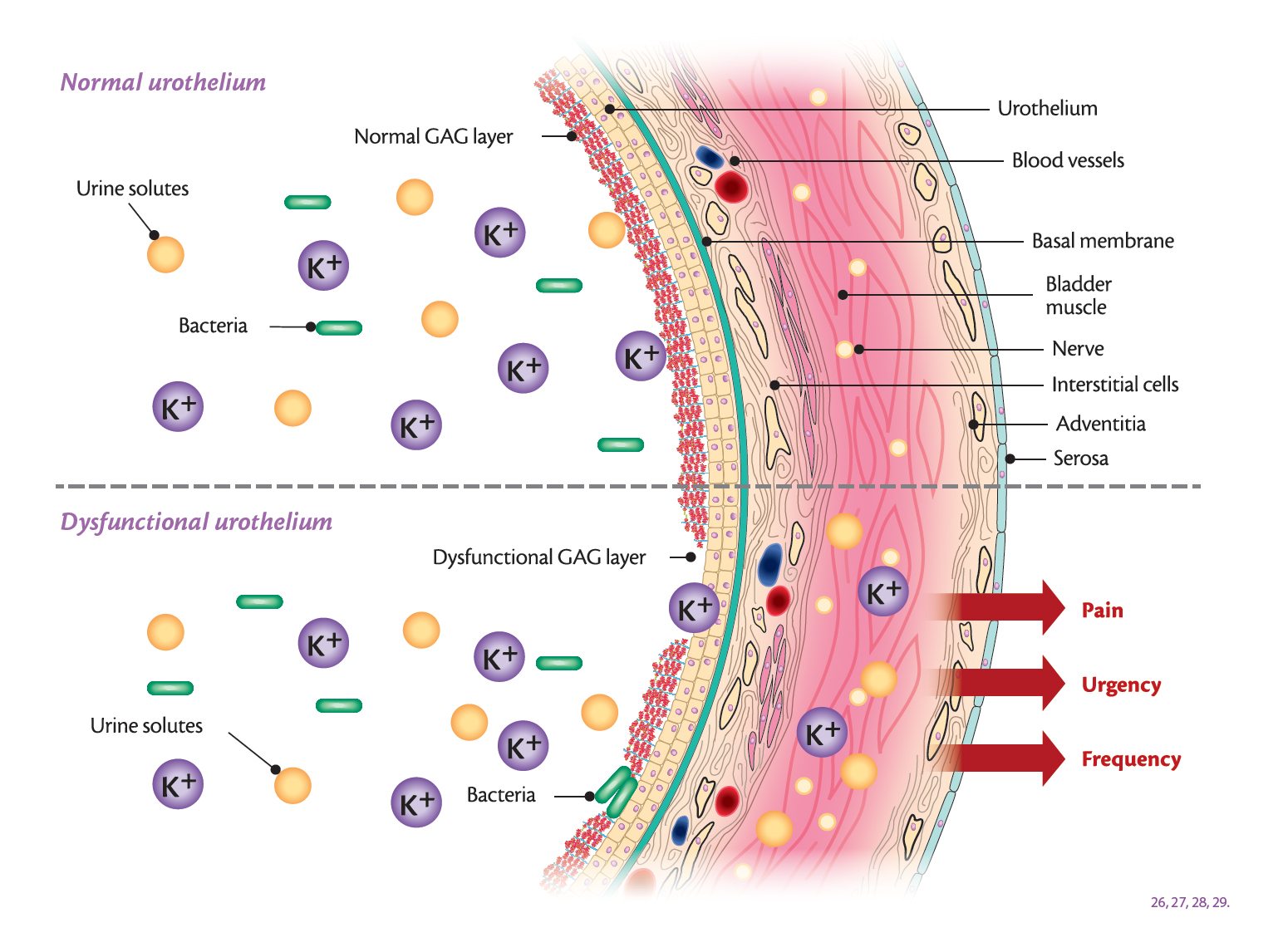 iAluRil for Interstitial Cystitis and Painful Bladder Syndrome