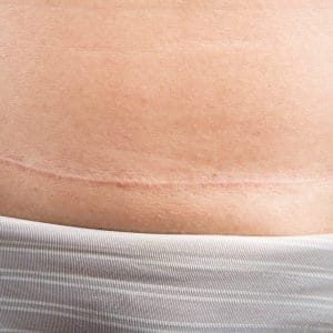 Caesarean scar
