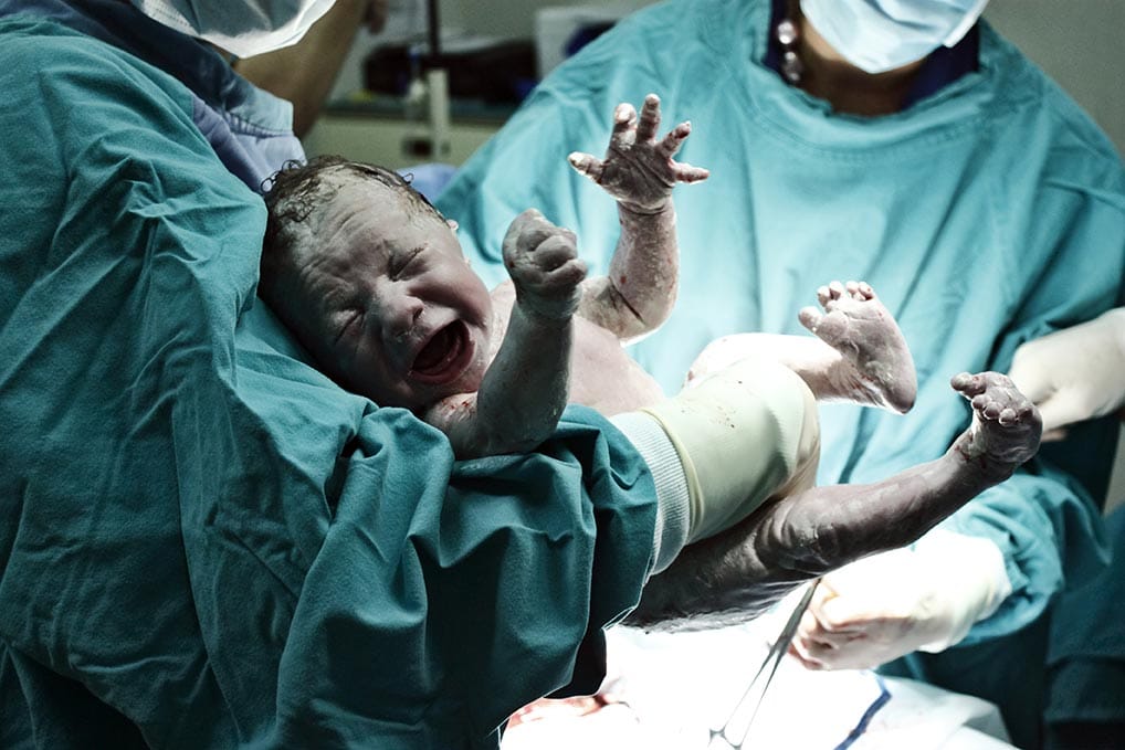 Baby is born via caesarean