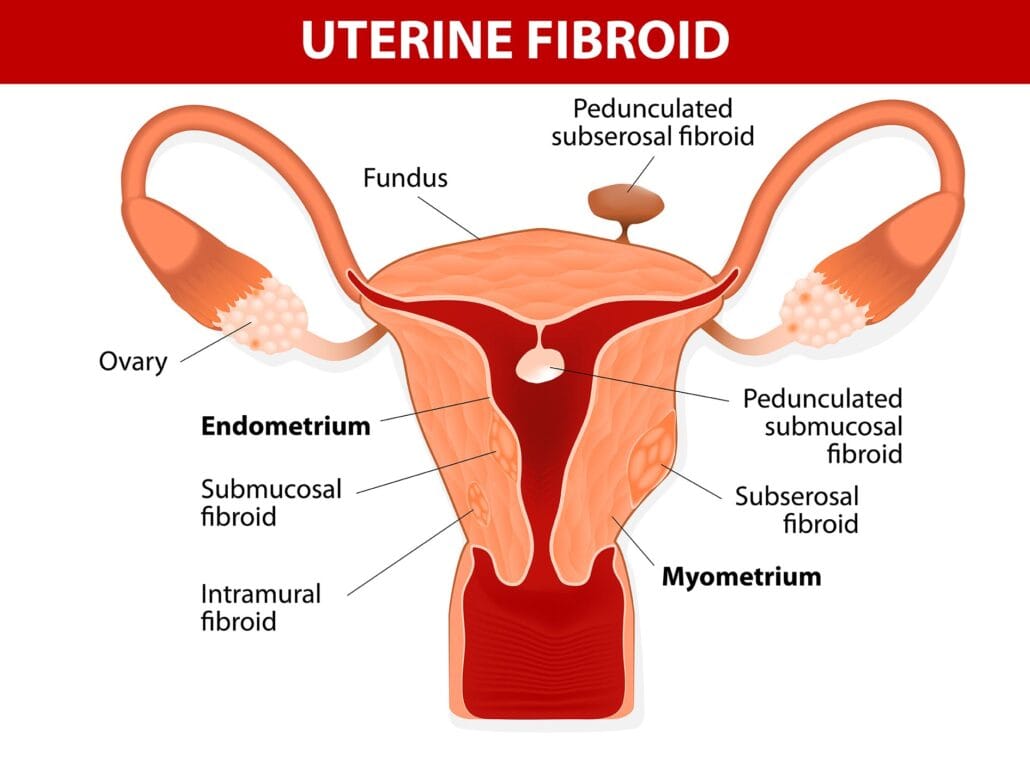 Uterine fibroids